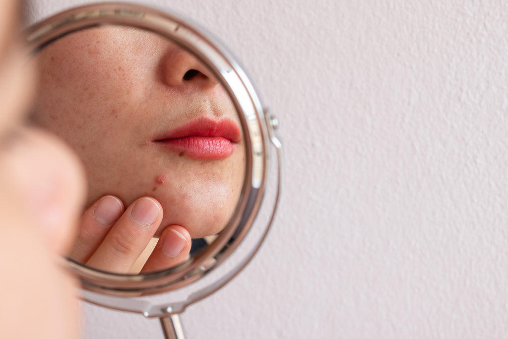 A Comprehensive Guide to Treating and Preventing Acne Scars