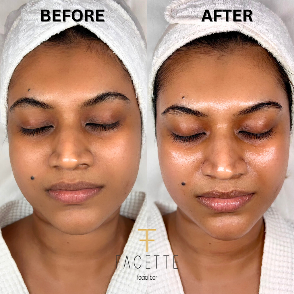 Lift and Sculpt Your Face in Just 1 Hour!