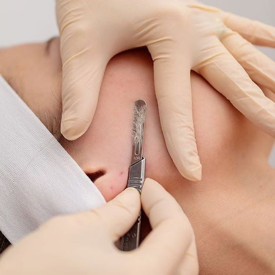 Meet Dermaplaning, the Facette Way