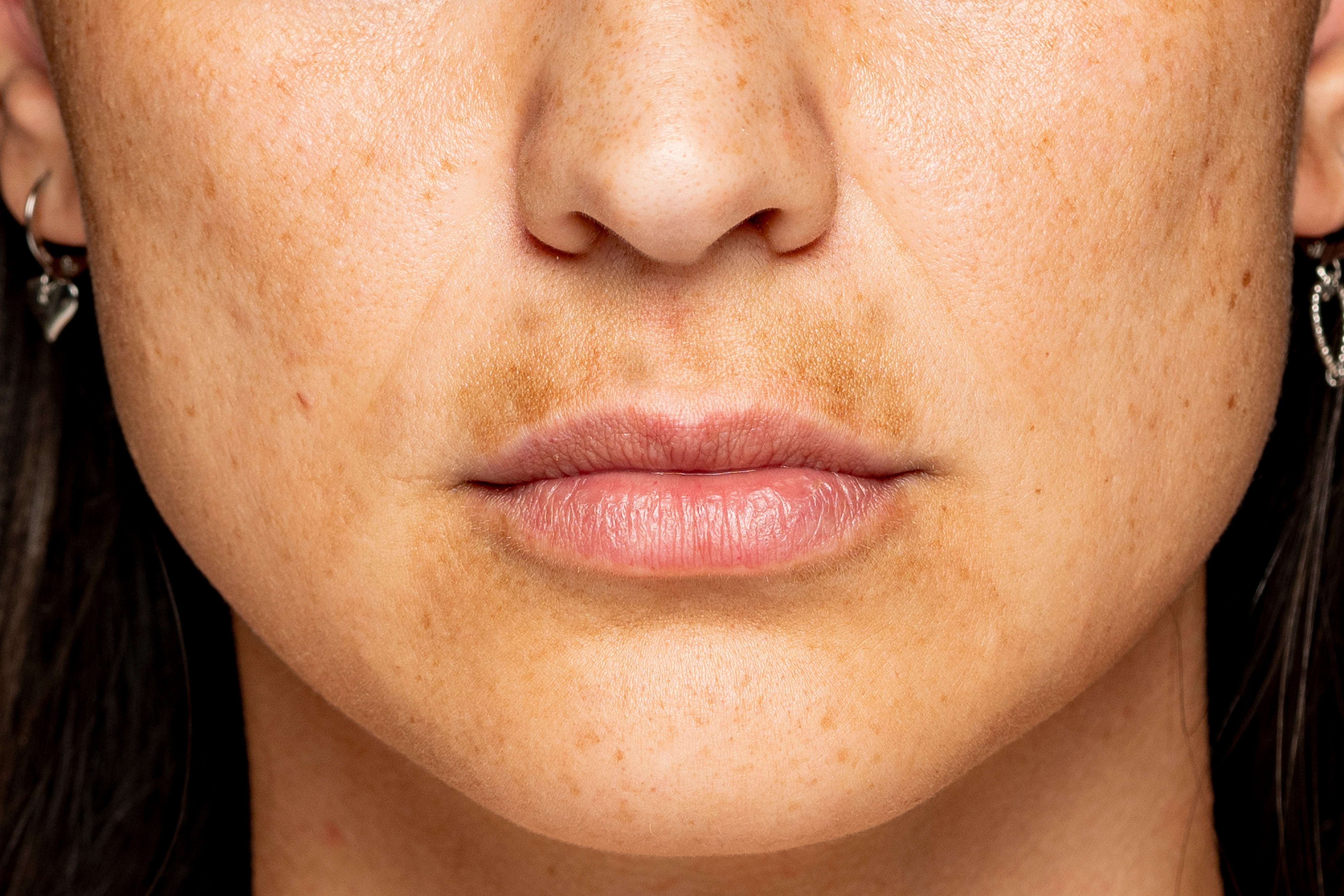 July Pigmentation Awareness Month: Achieving An Even Skin Tone